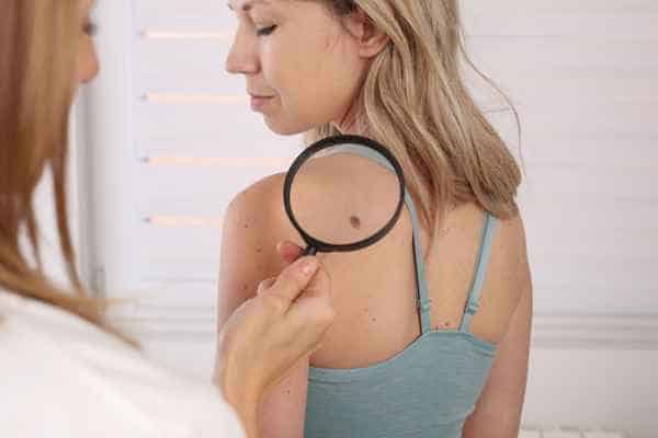 What Are Traditional Skin Lesion Removal Methods Sidcup?
