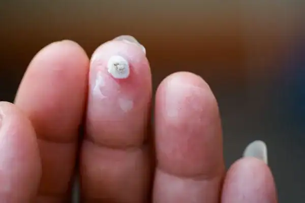 Image of white wart before cryopen treatment Sidcup