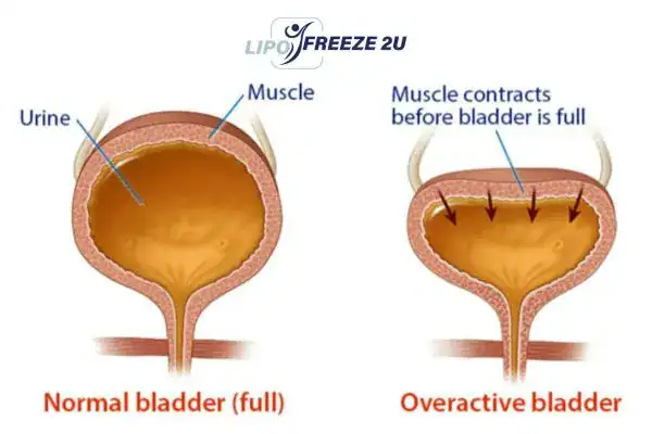 diagram of overactive bladder treatment Sidcup