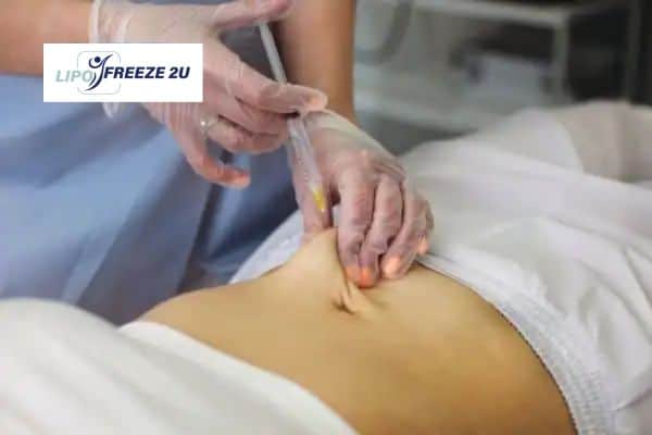 How Does Aqualyx Fat Dissolving Injection Work to Break Down Fat Sidcup?