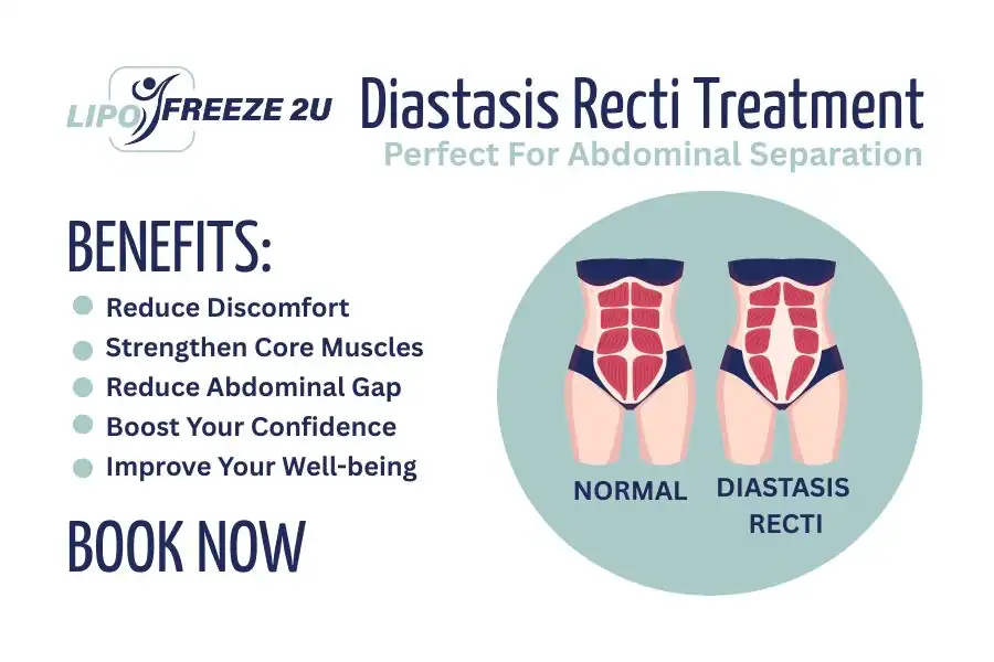Benefits of body toning treatment Sidcup for Diastasis recti