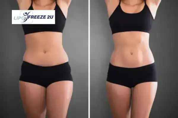 How Can LIPO FREEZE 2U Support Your Post-Pregnancy Body Recovery Sidcup?