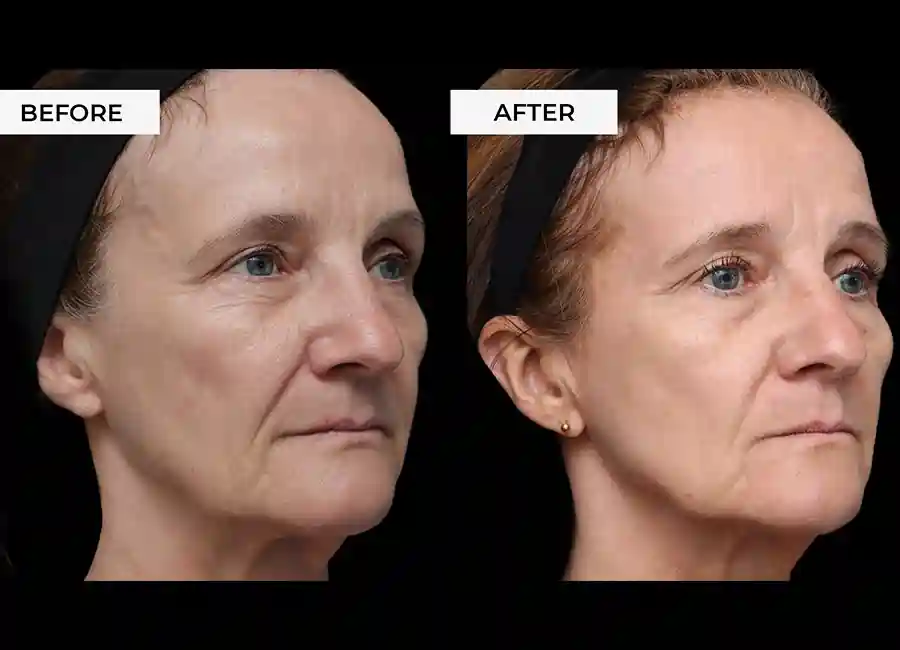 How Many RF Microneedling Sessions Will You Need to See a Difference Sidcup?