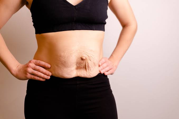Is Surgery Really the Only Way to Repair Diastasis Recti Sidcup?