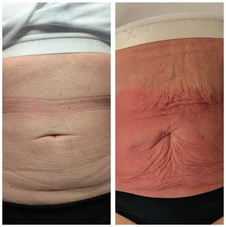 How Does RF Microneedling Improve Crepey, Thin and Uneven Skin Texture Sidcup?