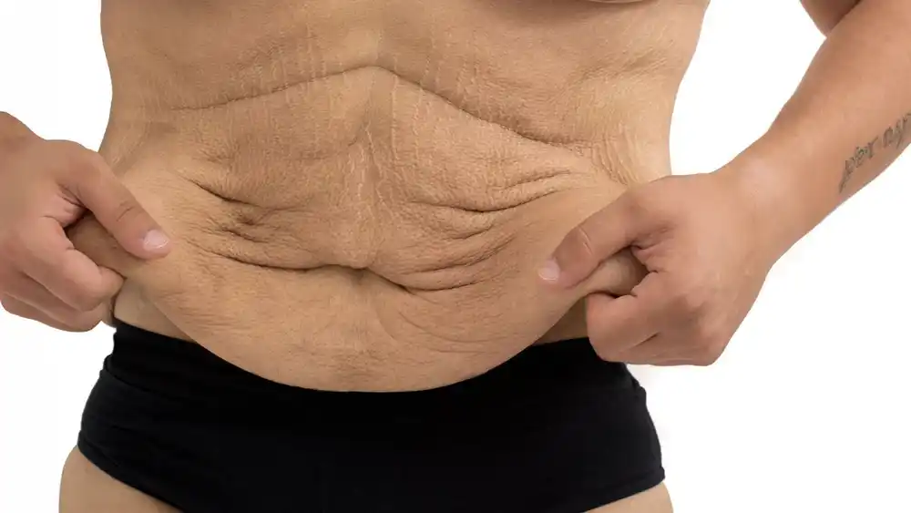 RF Microneedling for Loose Skin: How Can It Help Tighten and Reshape the Skin Sidcup?